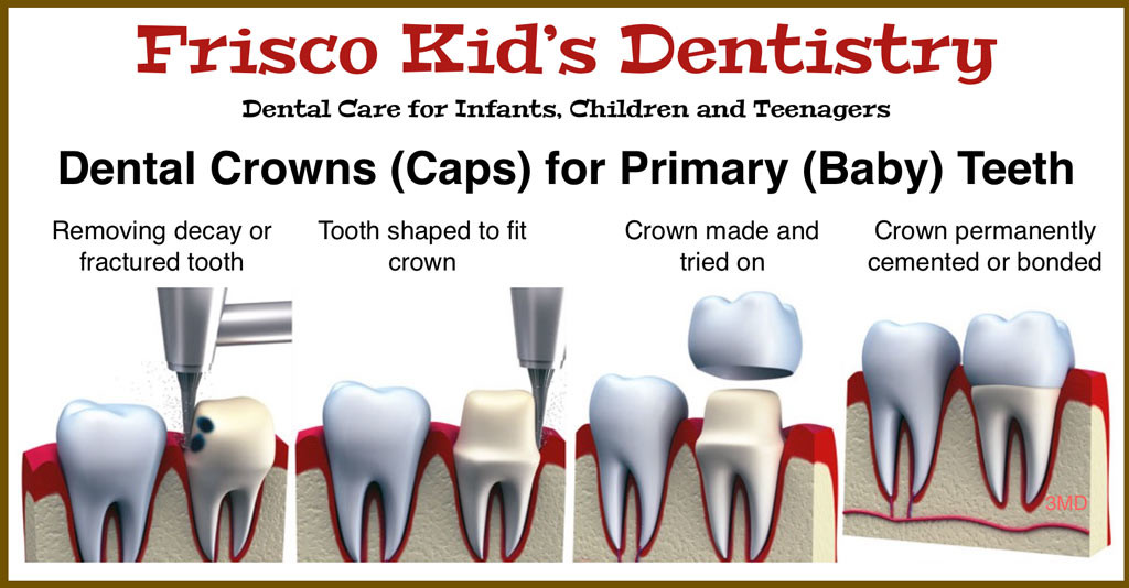 Dr Rubin provides dental crowns for baby teeth