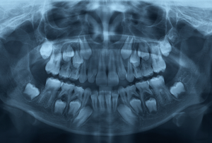 dental x-ray in child