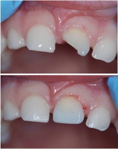 Tooth fracture, reattachment of the tooth fragment
