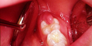 inlamed gums