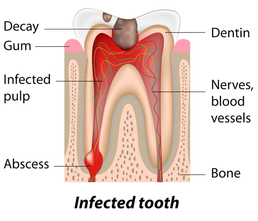 Infected-Abscessed-tooth-pain