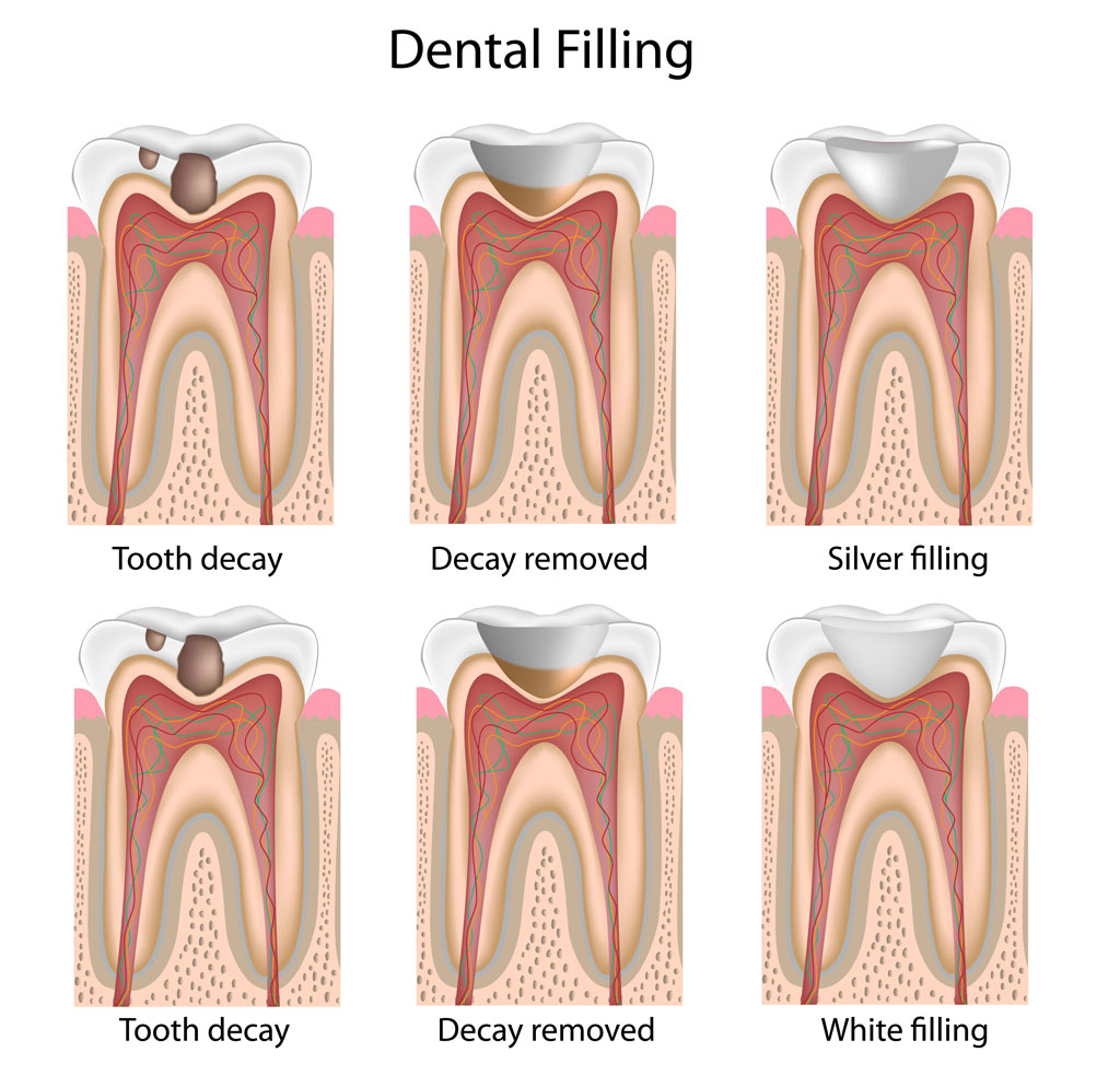cavity fillings