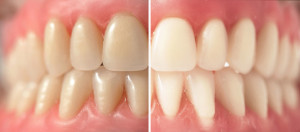teeth whitening in teenagers