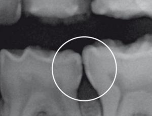 Interproximal Tooth Decay