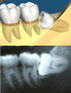 X-ray Panorex of Horizontal Impacted Tooth 