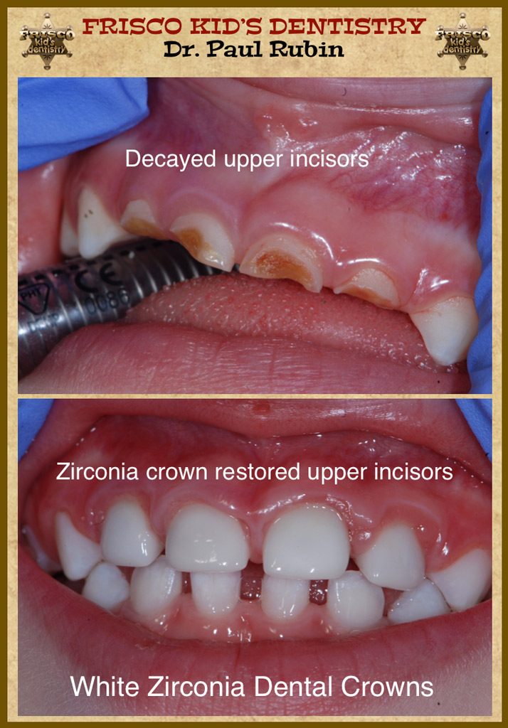 White zirconia dental crowns are a stainless steel crown alternative for children