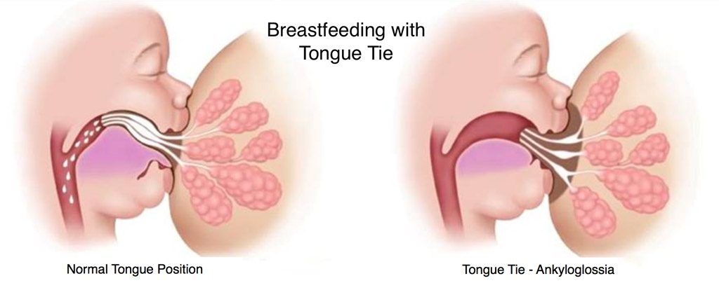 After laser frenectomy your infant’s postsurgical care Breastfeeding with Tongue Tie or Lip Tie