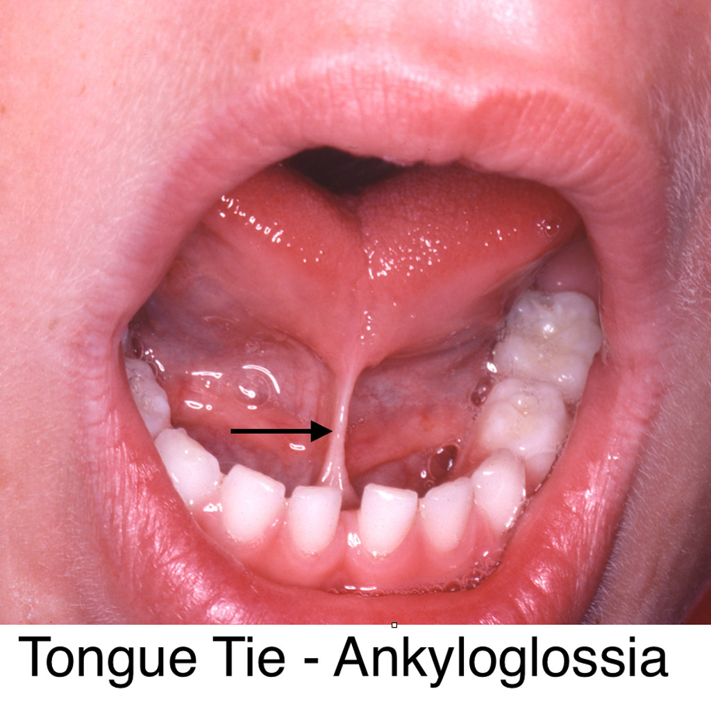 Frisco Kid's Dentistry Tongue Tie procedure