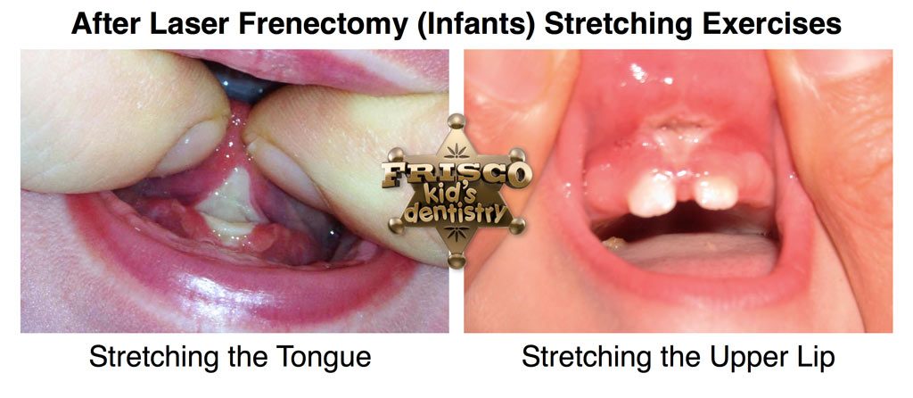 Dr Rubin provides information about Sucking exercises to improve nursing after laser frenectomy in Frisco and Dallas