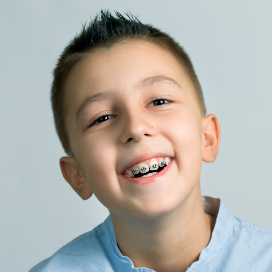 Pediatric Dentist Frisco Kids Dentistry - age for braces