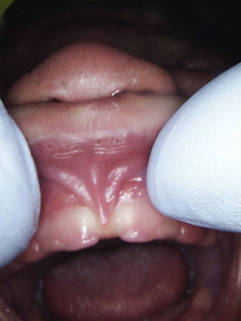 Frisco Kid's Dentistry Lip Tie procedure before photo